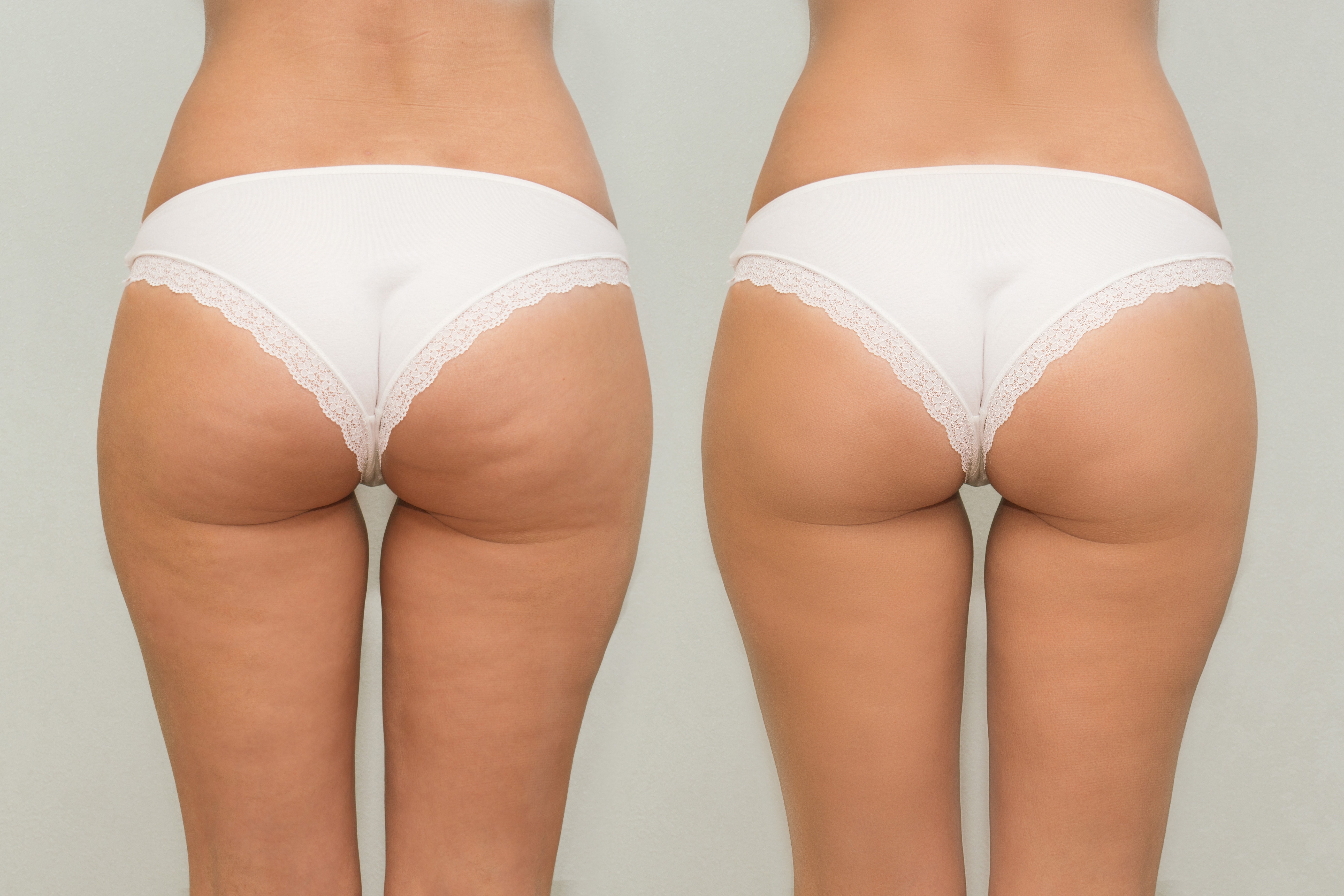 Female buttocks before and after treatment comparison